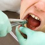 Sau khi nhổ răng khôn nên làm gì và không nên làm gì?