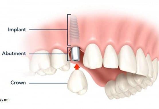 trồng răng bằng phương pháp implant