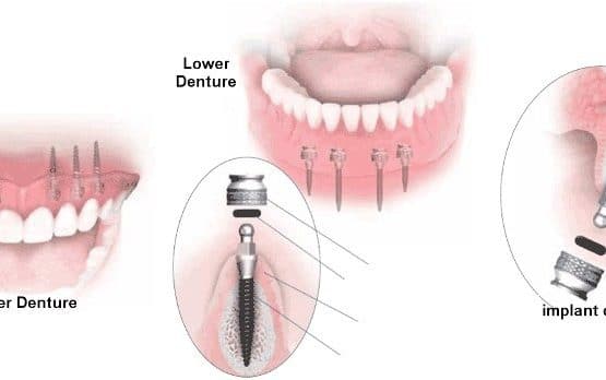 trồng răng bằng phương pháp implant