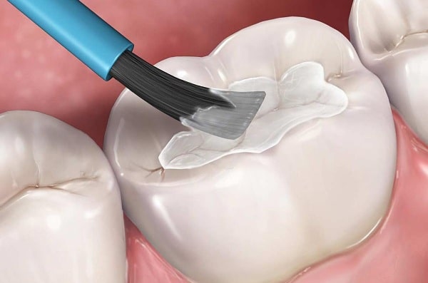 trám răng thẩm mỹ có bền không