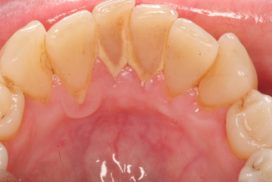 Khi nào nên lấy cao răng để có đảm bảo sức khỏe răng miệng? 