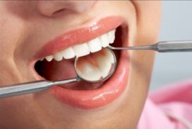 Giải đáp: trám răng sâu lỗ to bao nhiêu tiền tại thành phố Hồ Chí Minh? 