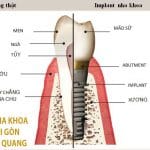 Những điều cần biết về kỹ thuật trồng răng implant