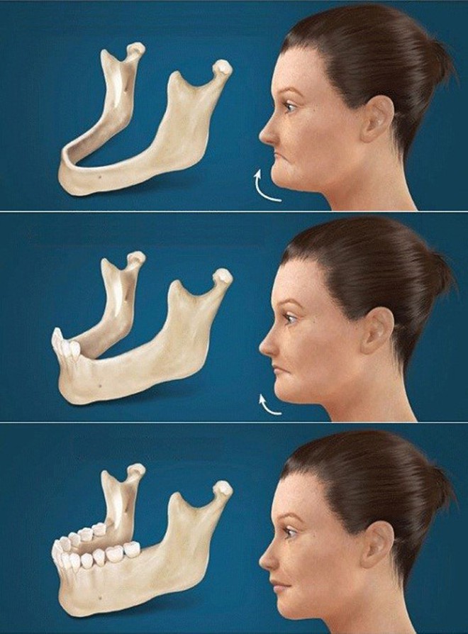diễn tiến tình trạng tiêu xương hàm khi mất răng ở người lớn