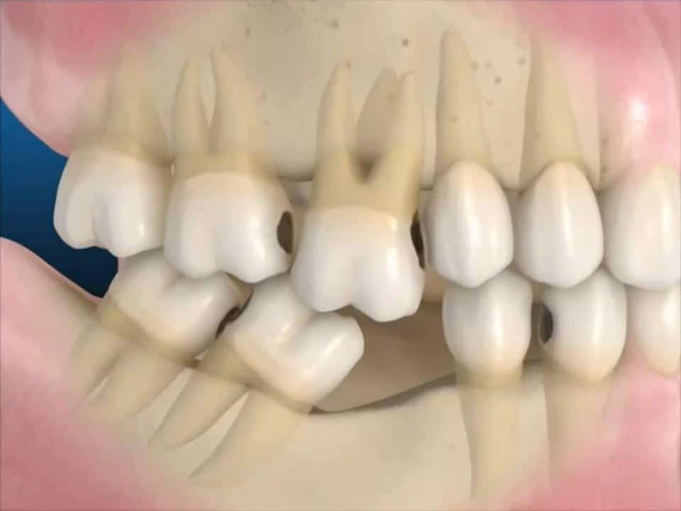 răng nghiêng lệch xoay gây nhồi nhét thức ăn khi không trồng răng