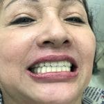 Trồng răng bằng phương pháp implant: ưu điểm, nhược điểm, tuổi nào trồng implant, quy trình trồng, có đau không, tuổi thọ răng implant, chi phí nhiêu tiền, chọn loại Implant nào phù hợp.