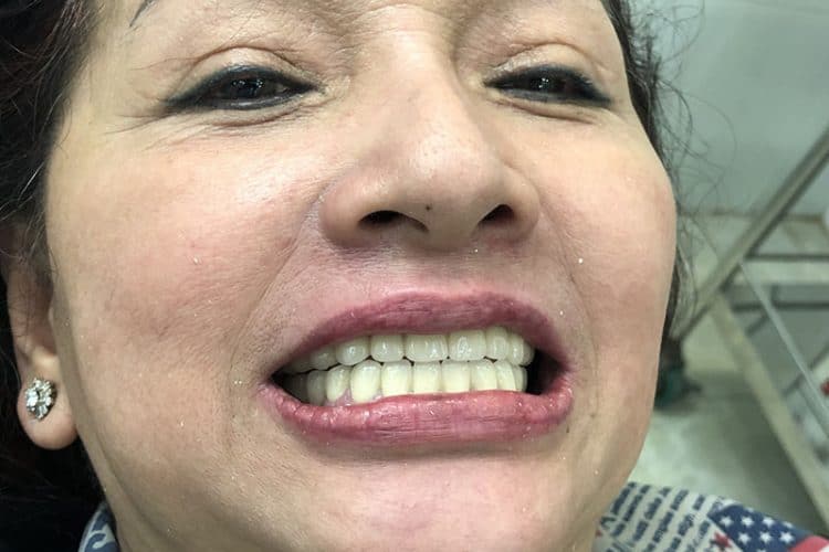 trồng răng implant đạt thẩm mỹ cao