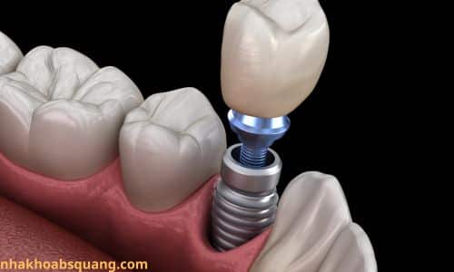 trồng răng implant, cấy ghép implant, bọc răng sứ- Nha Khoa Sài Gòn BS Quang