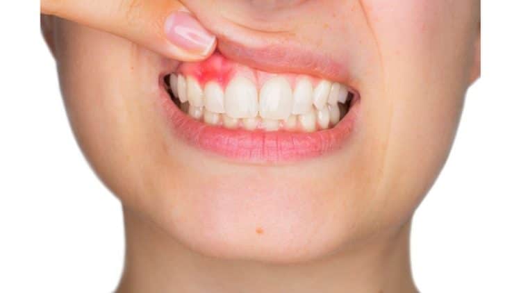 Phòng Viêm Mô Mềm Dị Ứng Hiệu Quả Tại Nhà