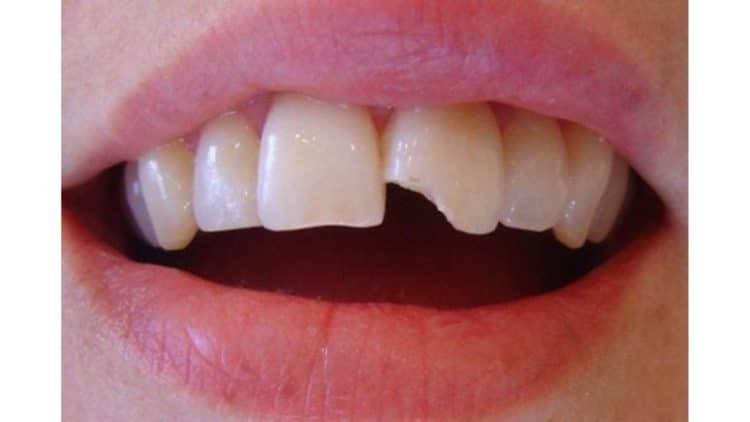 Chấn Thương Miệng Tai Nạn: Giải Pháp Phục Hình Nhanh Chóng và An Toàn