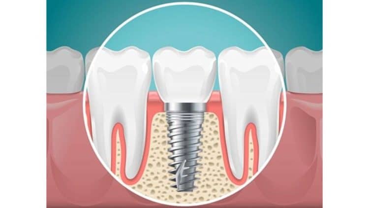 Yếu Tố Ảnh Hưởng Đến Tích Hợp Xương Trong Cấy Ghép Implant