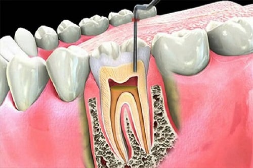 Các Phương Pháp Điều Trị Hiệu Quả Cho Viêm Tủy Tiêu Xương