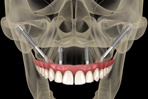 Cấy ghép Implant: Giải pháp phục hồi xương hàm hiệu quả