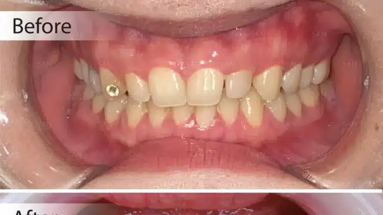 Điều Trị Viêm Nướu Lan Tỏa: Giải Pháp Tận Gốc Ngăn Ngừa Biến Chứng