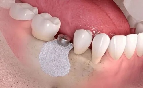 Giải Pháp Cấy Ghép Implant Khắc Phục Tiêu Xương Hàm