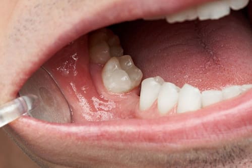 Lý Do Mất Xương Hàm Xảy Ra và Ảnh Hưởng Tới Sức Khỏe Răng Miệng