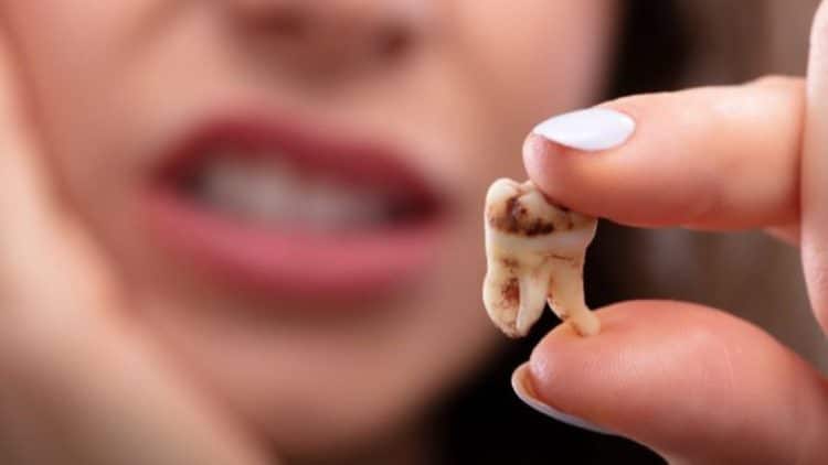 Nhổ Răng Khôn Kiêng Ăn Gì Để Mau Lành Nhanh Chóng