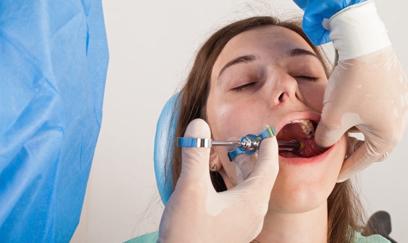Những Lưu Ý Quan Trọng Khi Nhổ Răng Khôn Để Tránh Biến Chứng