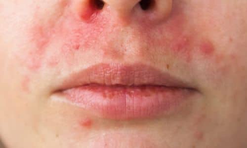 Những Triệu Chứng Điển Hình Của Viêm Mô Quanh Miệng