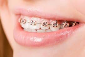 Quá Trình Niềng Răng Có Thể Ảnh Hưởng Đến Xương Hàm Như Thế Nào