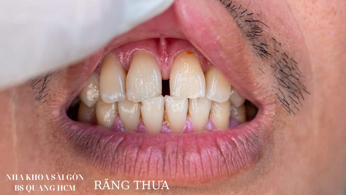 răng thưa bẩm sinh