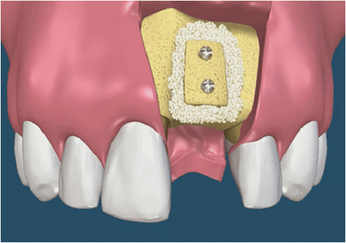 Tầm Quan Trọng Của Cấy Ghép Implant Trong Duy Trì Cấu Trúc Xương Hàm
