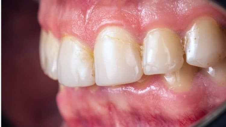 Tổn Thương Nướu Do Thuốc Lá: Nguyên Nhân Và Cách Khắc Phục Hiệu Quả