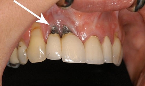 Triệu Chứng Phổ Biến Của Viêm Quanh Răng Implant