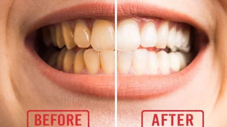 Tụt Lợi và Phục Hồi Hiệu Quả Cho Nụ Cười Rạng Rỡ