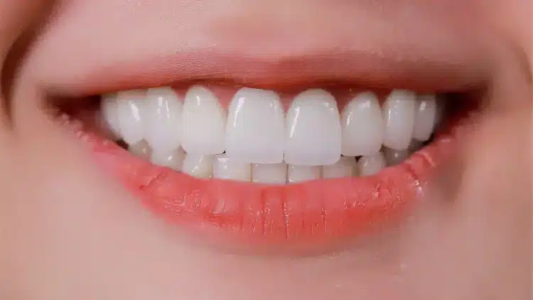 Viêm Lợi Do Vi Khuẩn Yếm Khí: Ngăn Ngừa Và Điều Trị Hiệu Quả