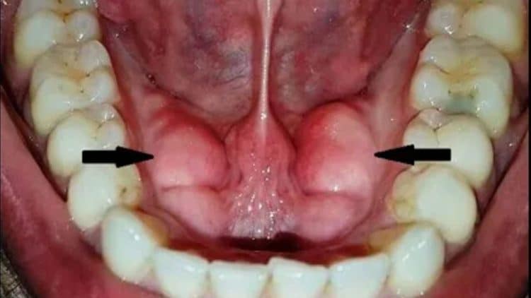 Viêm Xương Hàm Dưới Khuẩn: Nguy Cơ Và Cách Phòng Tránh