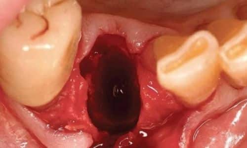Những Dấu Hiệu Nhận Biết Bạn Có Thể Đang Bị Nhiễm Trùng Xương Hàm