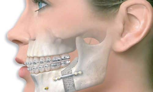 Cách Điều Trị Nhiễm Trùng Xương Hàm: Giải Pháp An Toàn Và Hiệu Quả