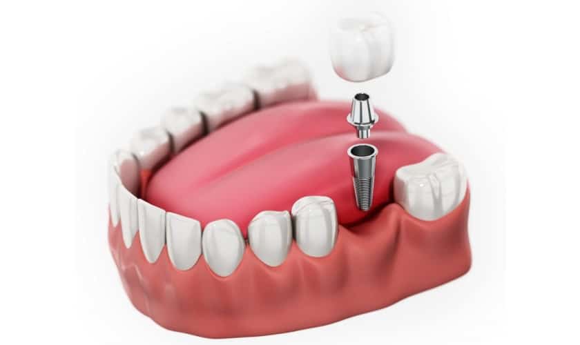 Chi phí cấy ghép răng hàm: Yếu tố ảnh hưởng và lựa chọn tối ưu