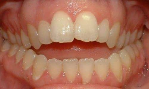 Chữa Trị Lệch Khớp Cắn Mòn Răng: Hành Trình Khôi Phục Nụ Cười