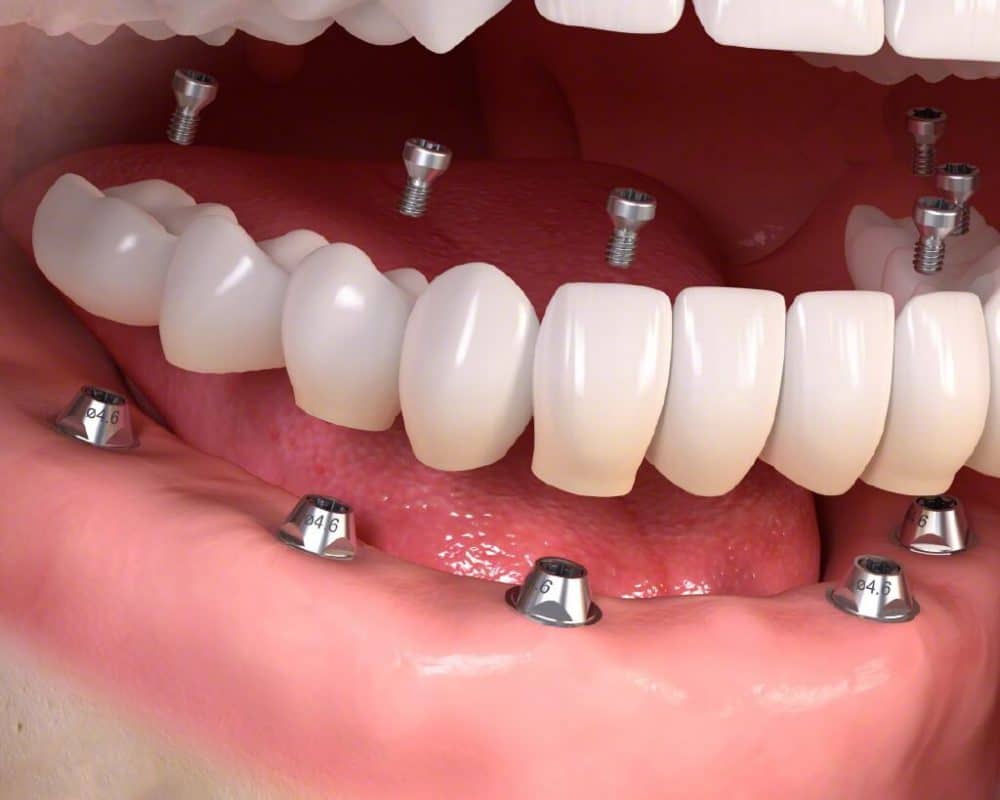 Trồng răng hàm có đau không? Những điều bạn cần biết