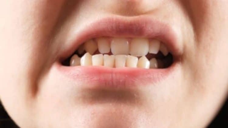 Lệch Khớp Cắn Mòn Răng: Nguyên Nhân Và Cách Khắc Phục Hiệu Quả