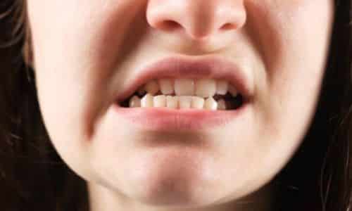 Hậu Quả Lệch Khớp Cắn và Mòn Răng: Những Điều Bạn Cần Biết