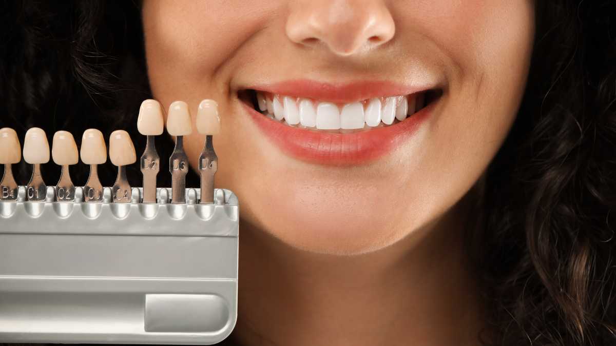mẫu răng sứ cercon-zirconia