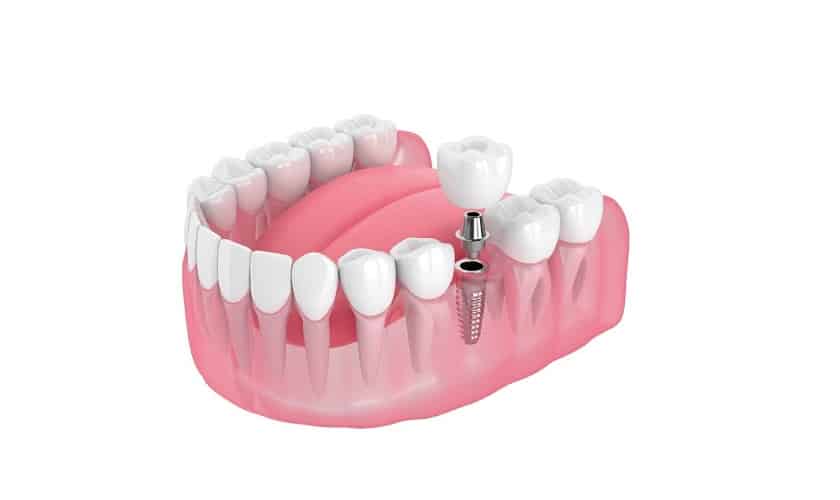 Tìm Hiểu Dịch Vụ Trồng Răng Giá Rẻ: Giải Pháp Hoàn Hảo Cho Nụ Cười Của Bạn