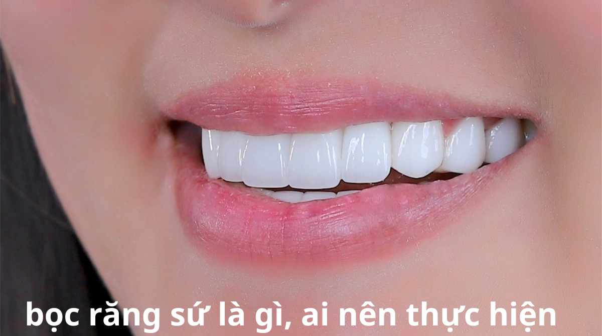 bọc răng sứ là gì, ai nên thực hiện