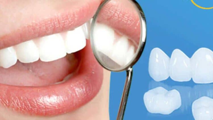 răng sứ veneer- nét đẹp tự nhiên